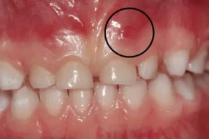 tooth abscesses what are they and what do ido if i see one on my child (1)