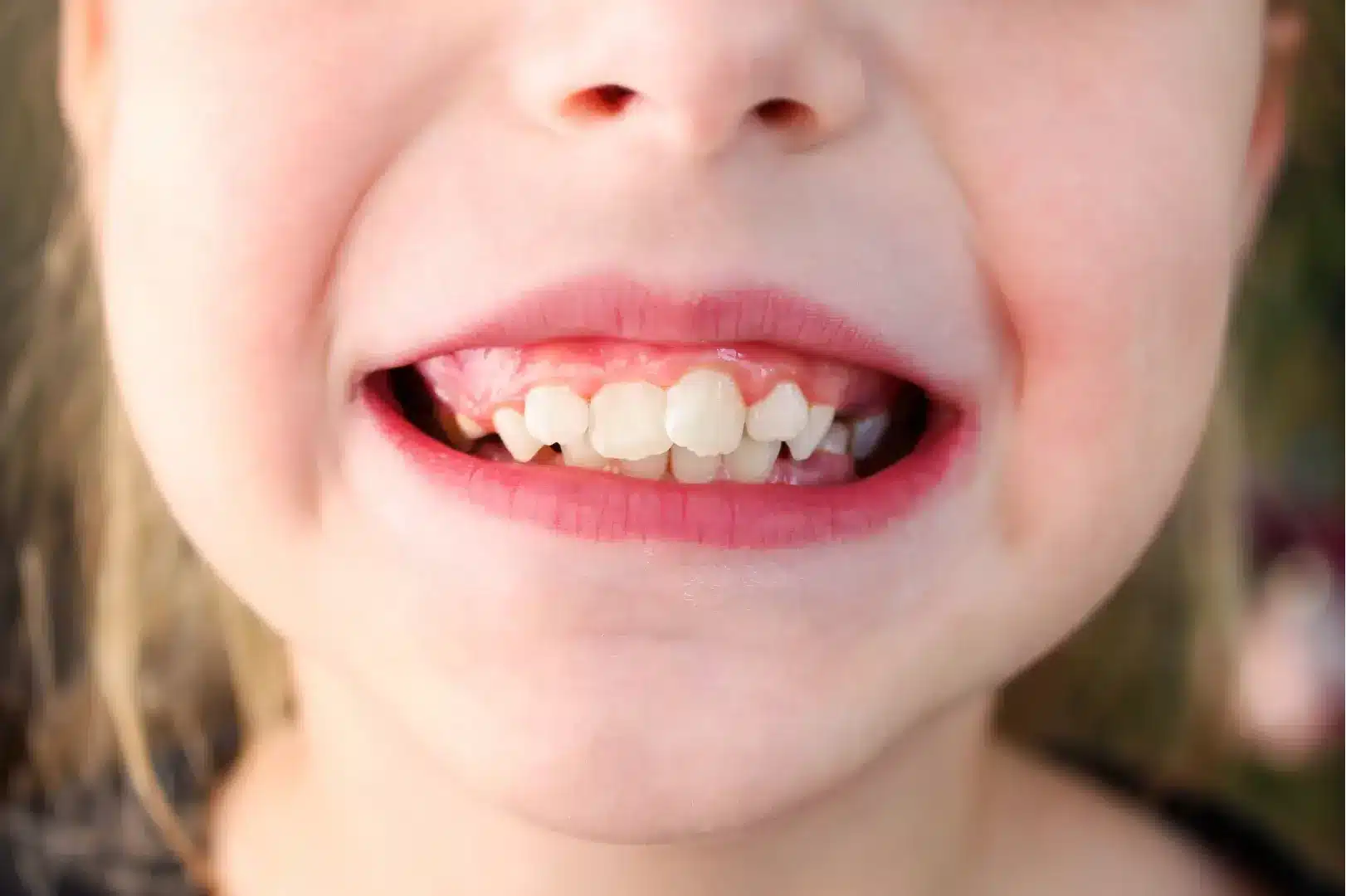 Symptoms Of Molars Coming In
